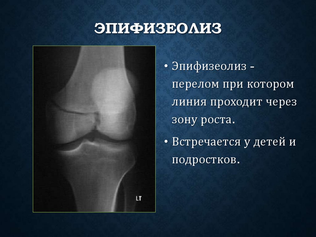 Эпифизеолиз