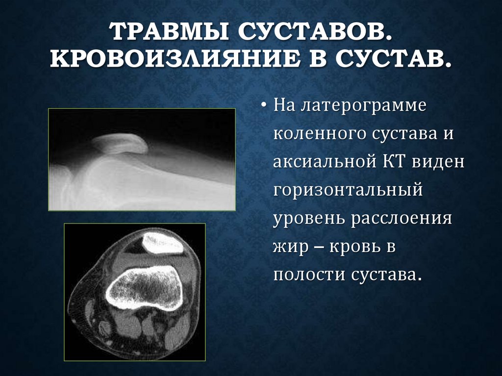 Травмы суставов. Кровоизлияние в сустав.