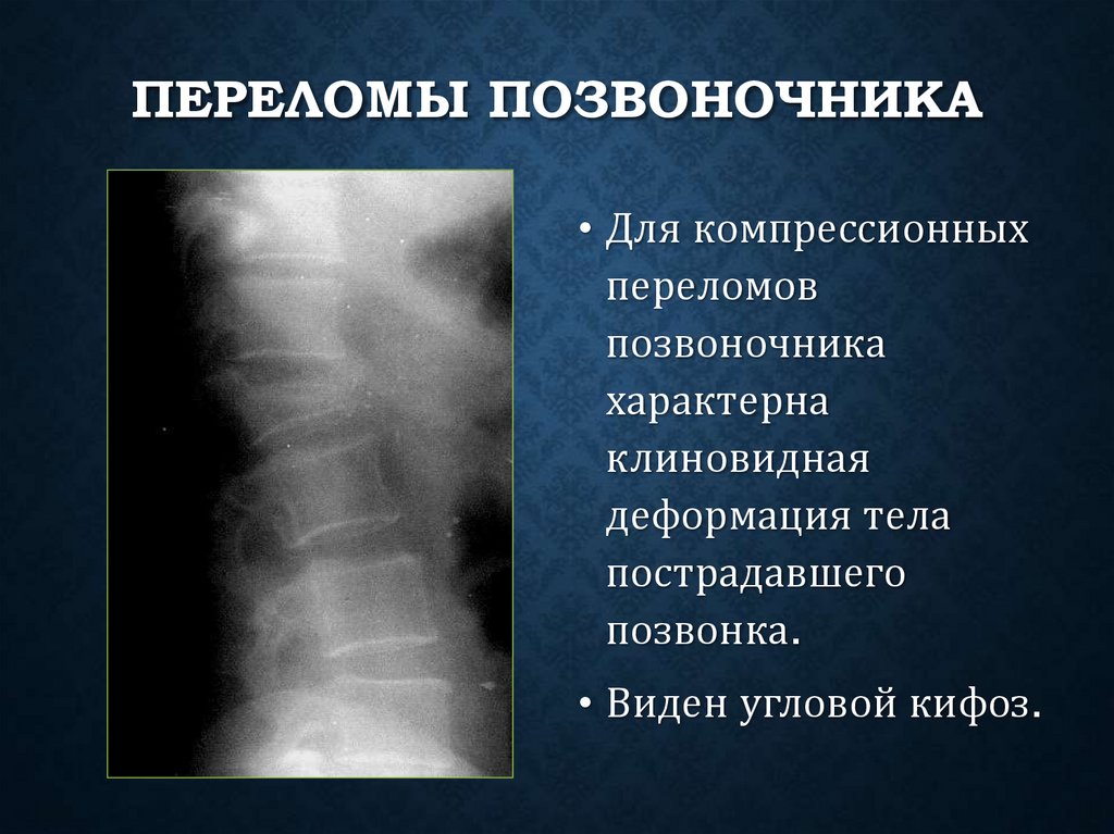Переломы позвоночника