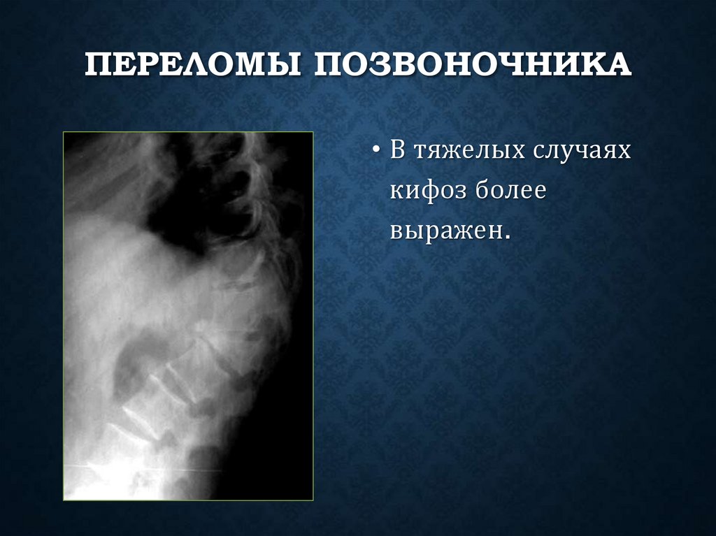 Переломы позвоночника