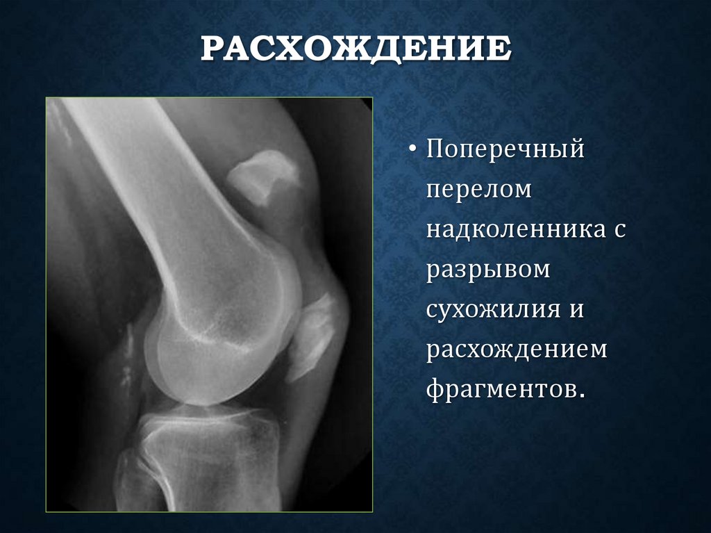 Расхождение