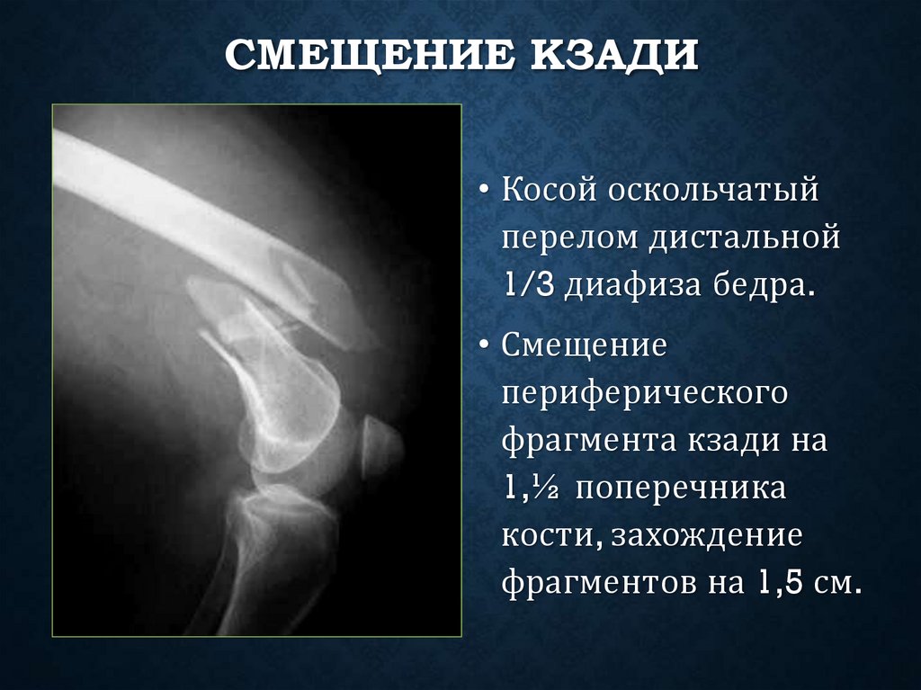 Смещение кзади