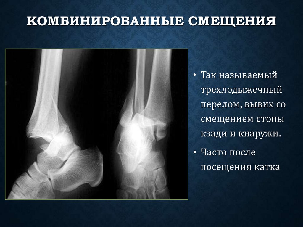 Комбинированные смещения