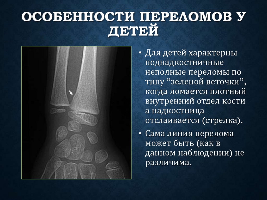 Особенности переломов у детей