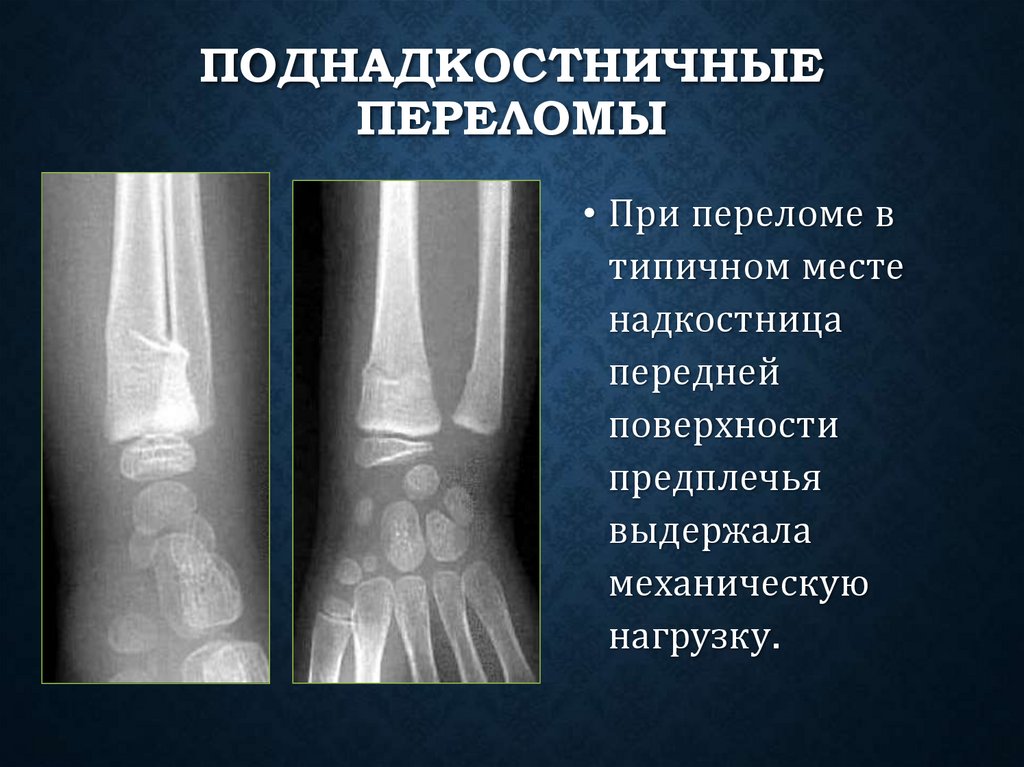 Поднадкостничные переломы