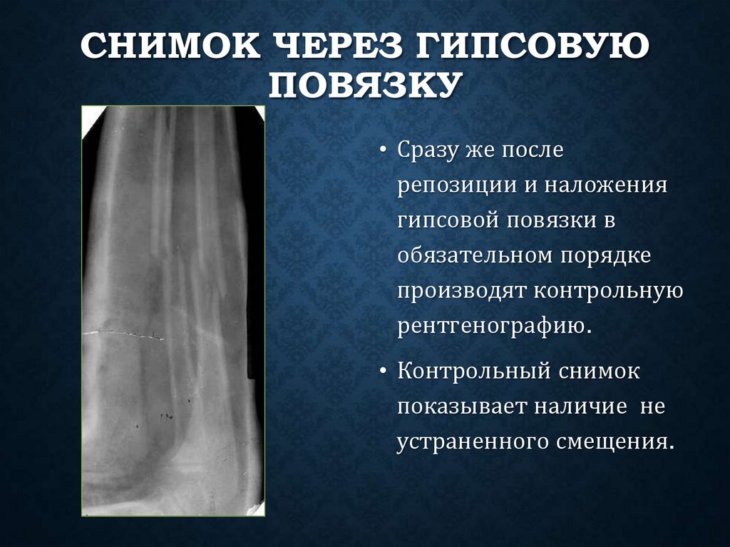 Снимок через гипсовую повязку