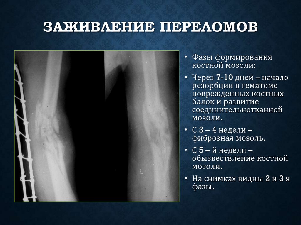 Заживление переломов