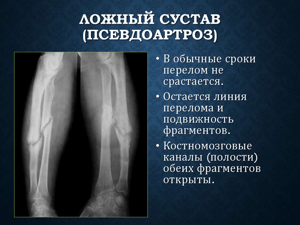 Ложный сустав (псевдоартроз)