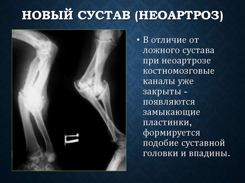 Новый сустав (неоартроз)