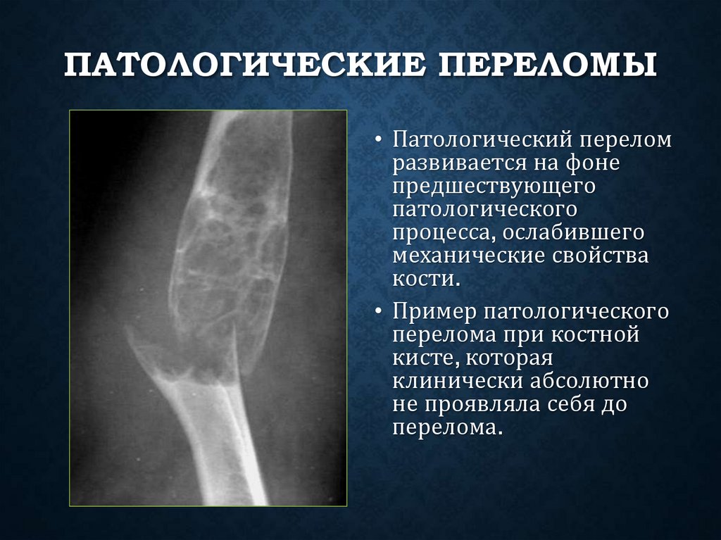 Патологические переломы