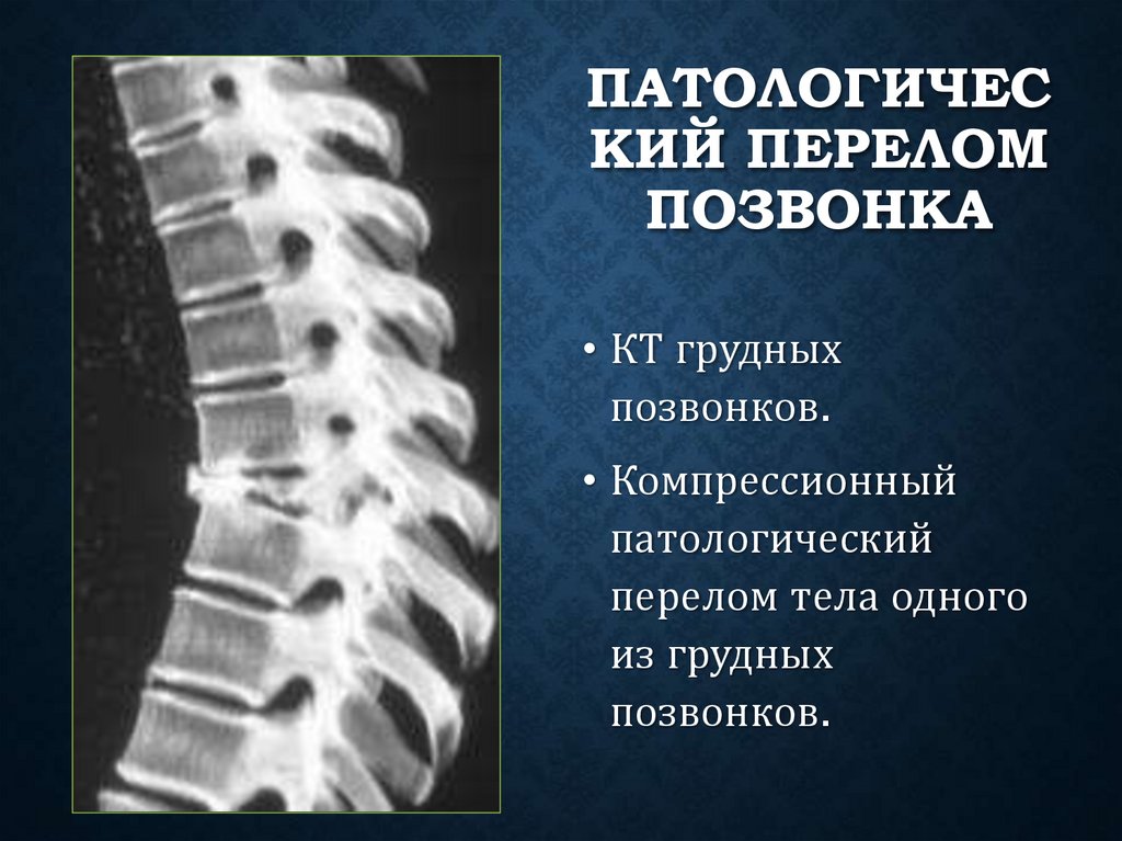Патологический перелом позвонка