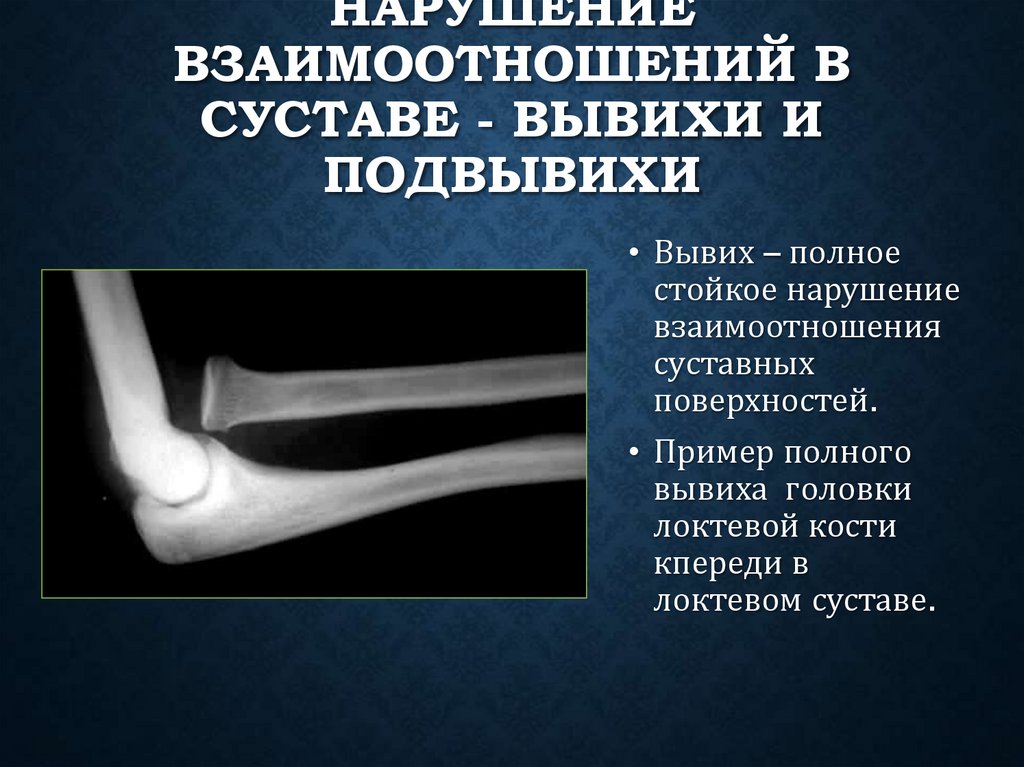 Нарушение взаимоотношений в суставе - вывихи и подвывихи
