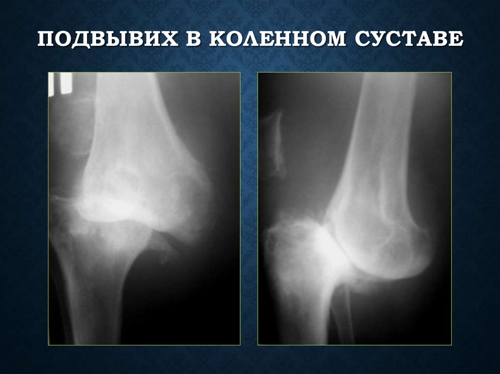 Подвывих в коленном суставе