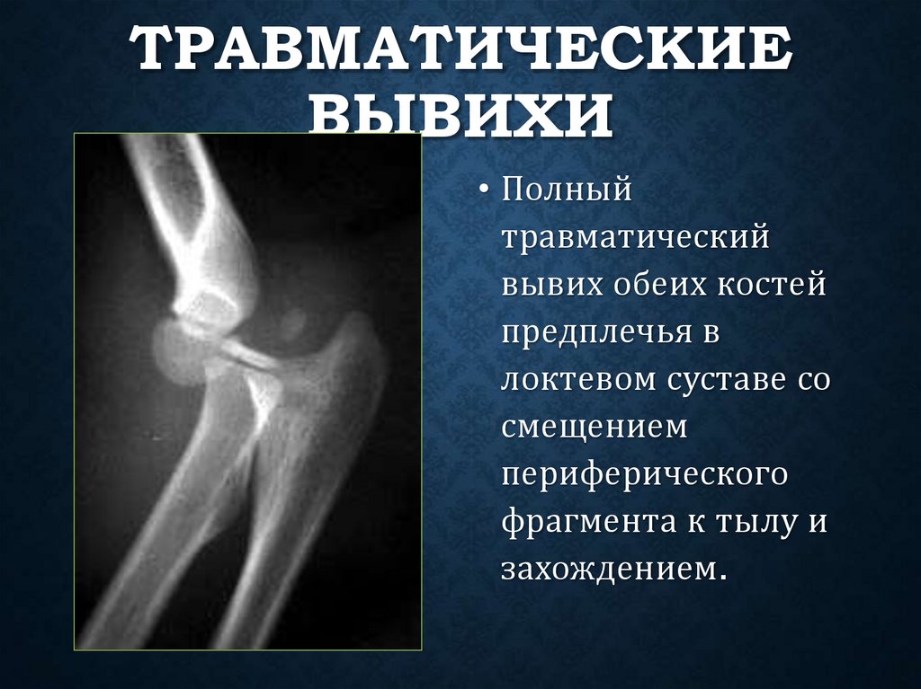 Травматические вывихи