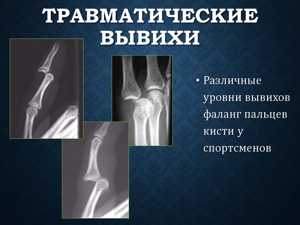 Травматические вывихи