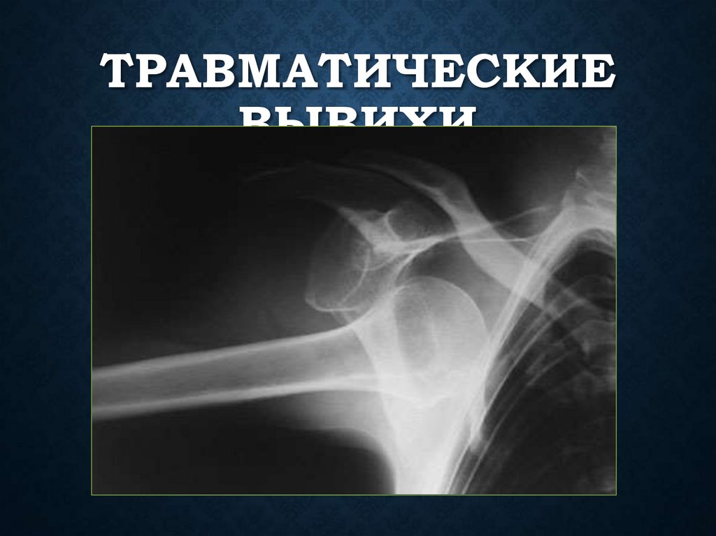Травматические вывихи