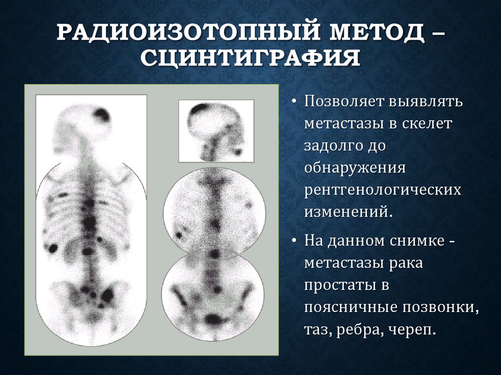 Радиоизотопный метод – сцинтиграфия