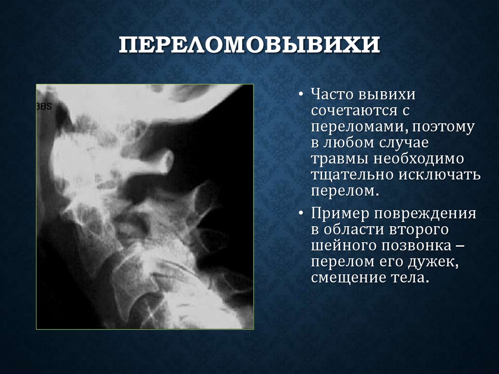 Переломовывихи