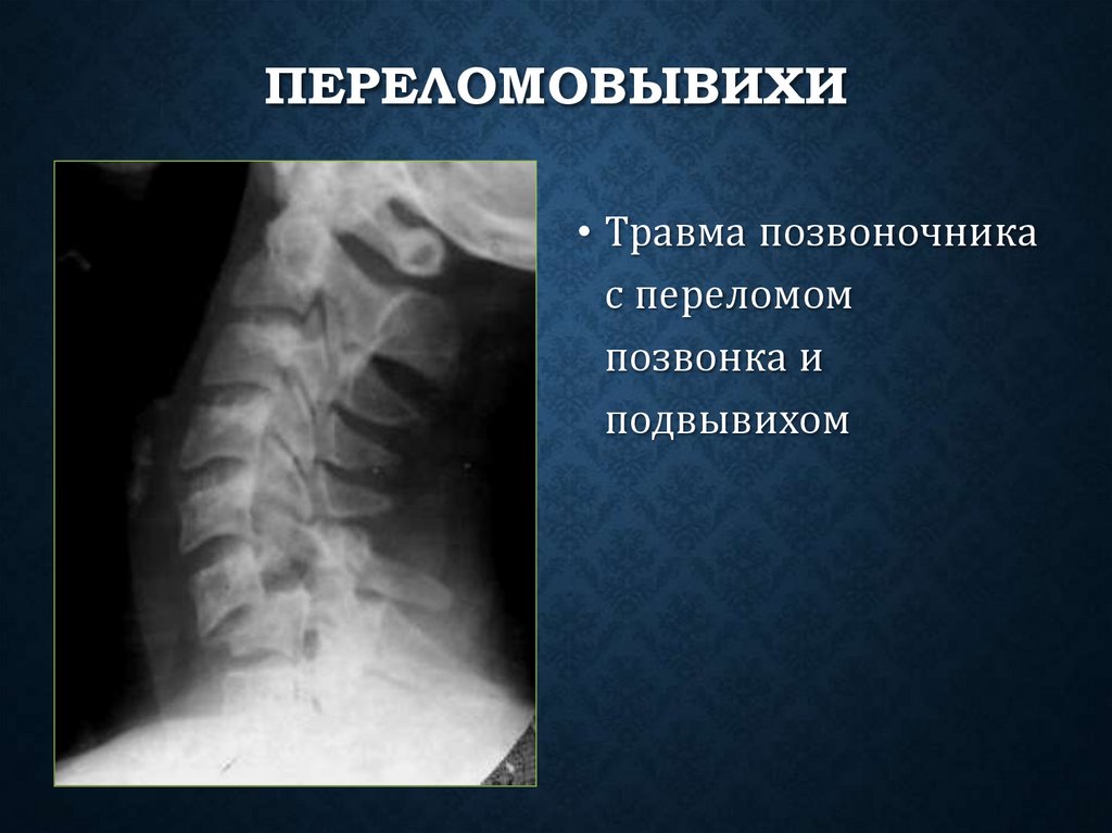 Переломовывихи