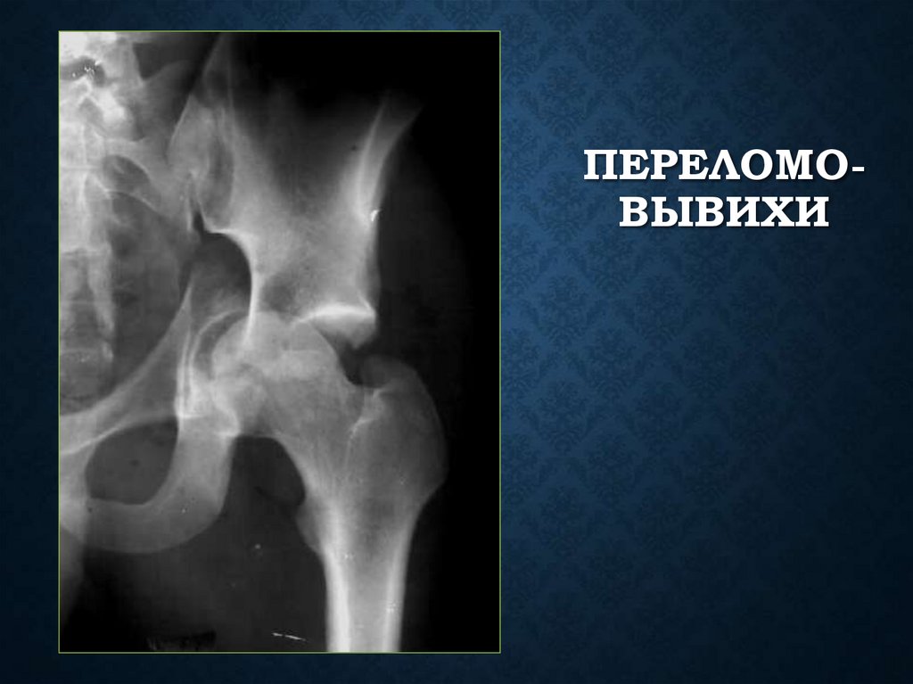 Переломо- вывихи