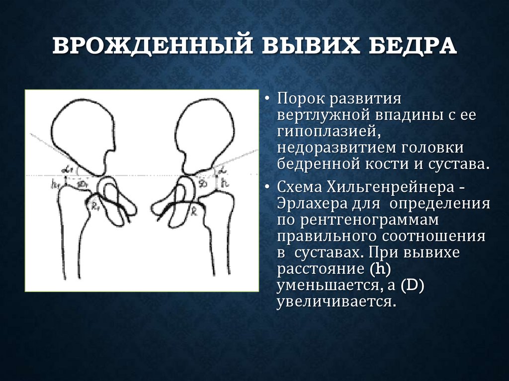 Врожденный вывих бедра