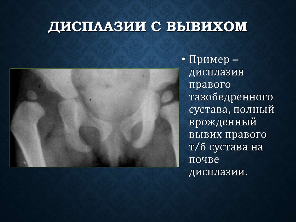 Дисплазии с вывихом