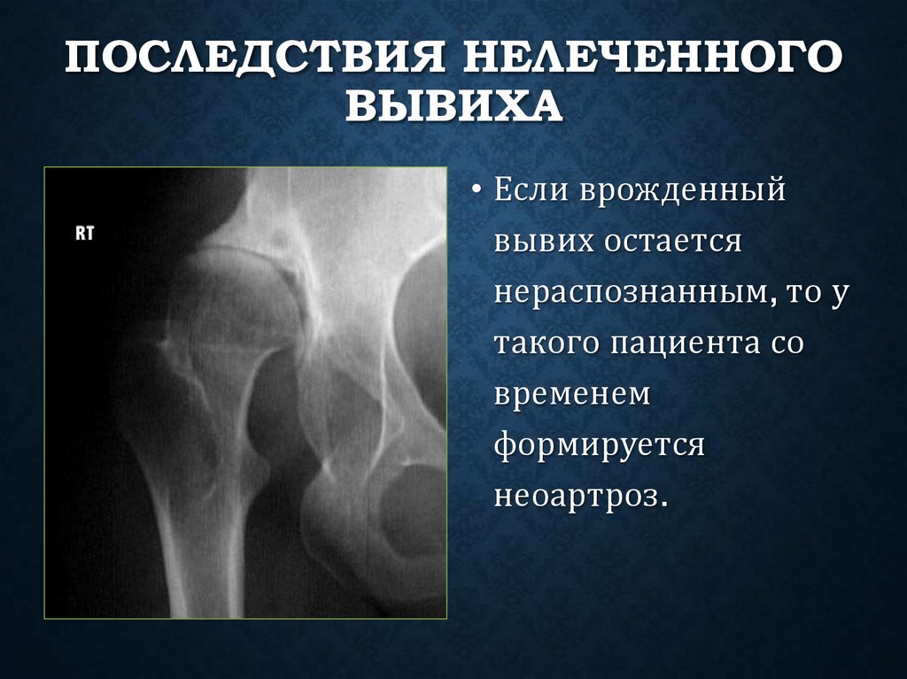 Последствия нелеченного вывиха