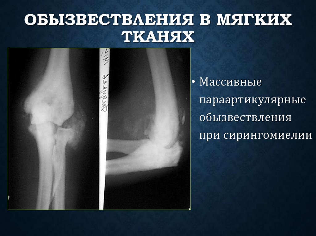 Обызвествления в мягких тканях