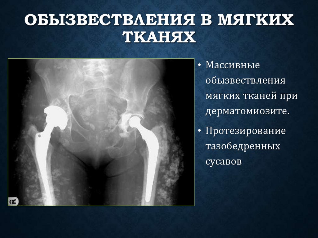 Обызвествления в мягких тканях