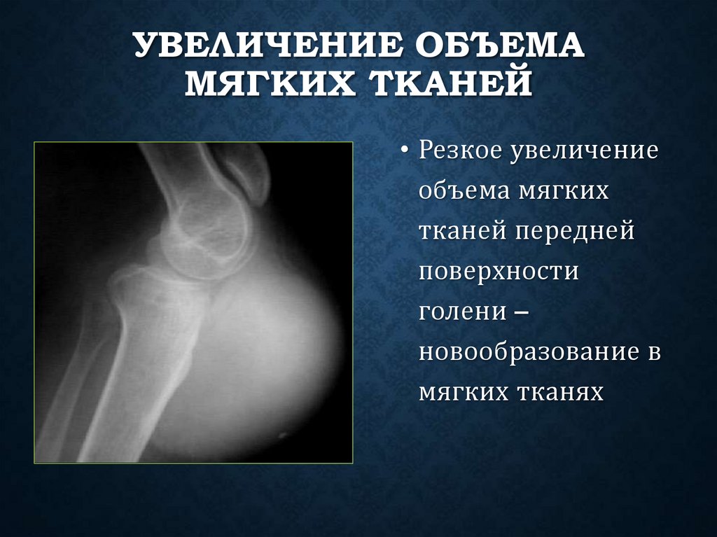 Увеличение объема мягких тканей