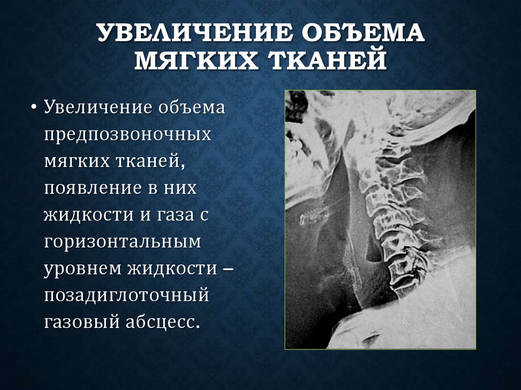 Увеличение объема мягких тканей