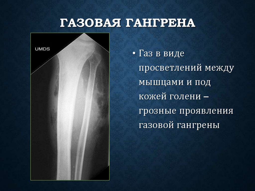 Газовая гангрена