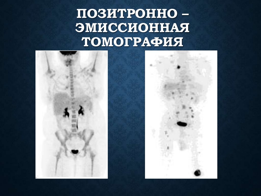 Позитронно – эмиссионная томография