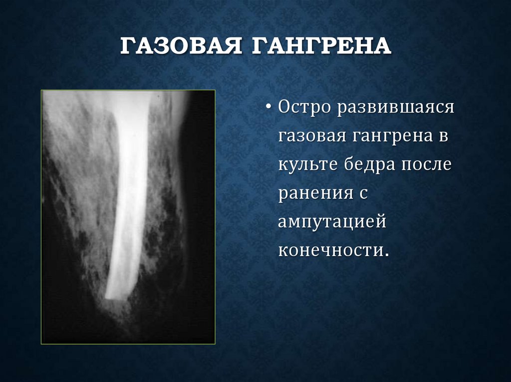 Газовая гангрена