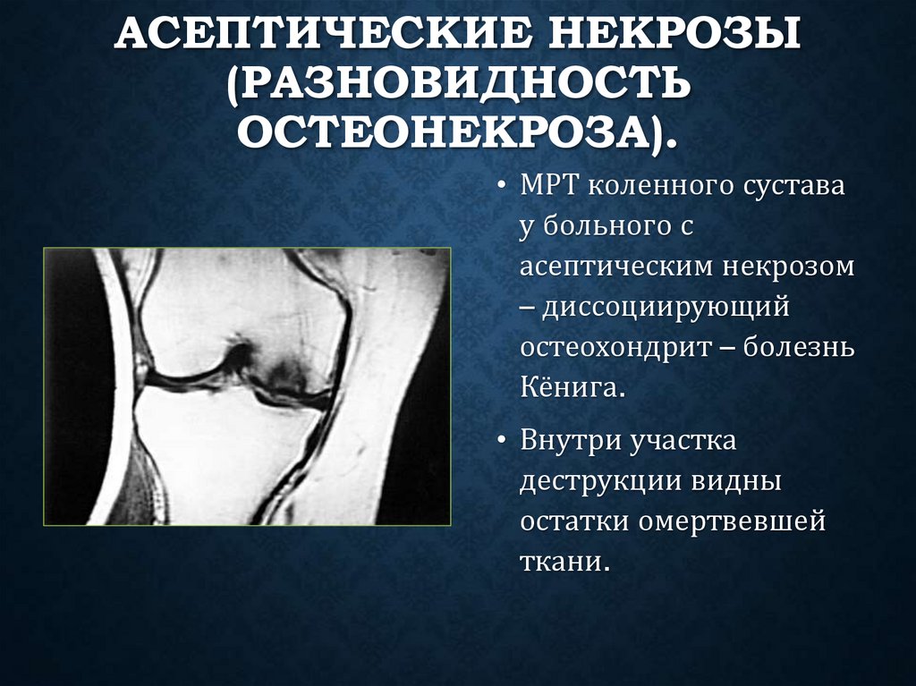 Асептические некрозы (разновидность остеонекроза).