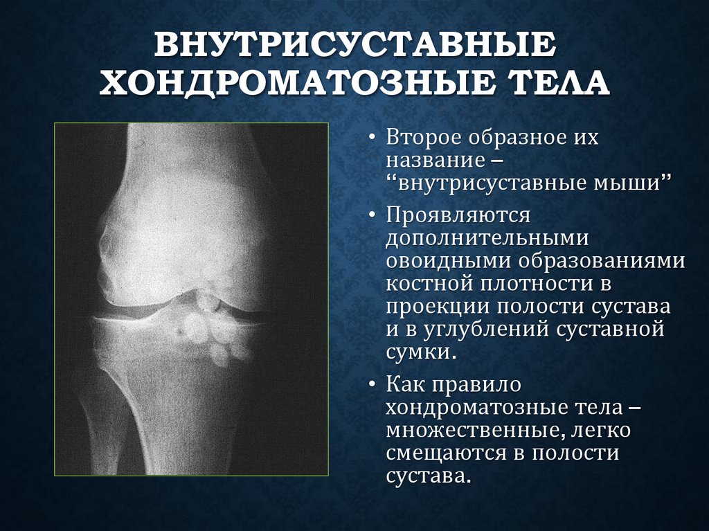 Внутрисуставные хондроматозные тела