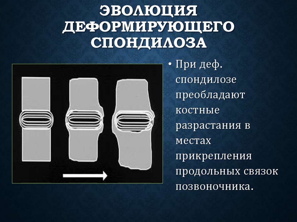 Эволюция деформирующего спондилоза