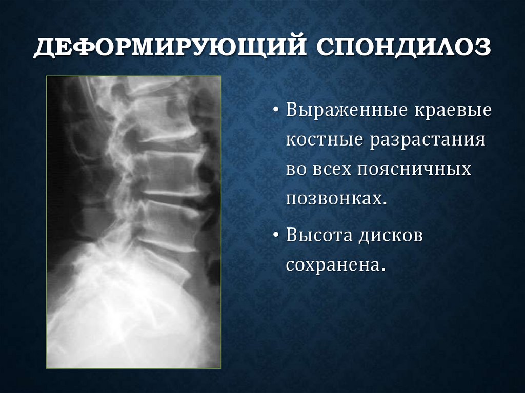 Деформирующий спондилоз