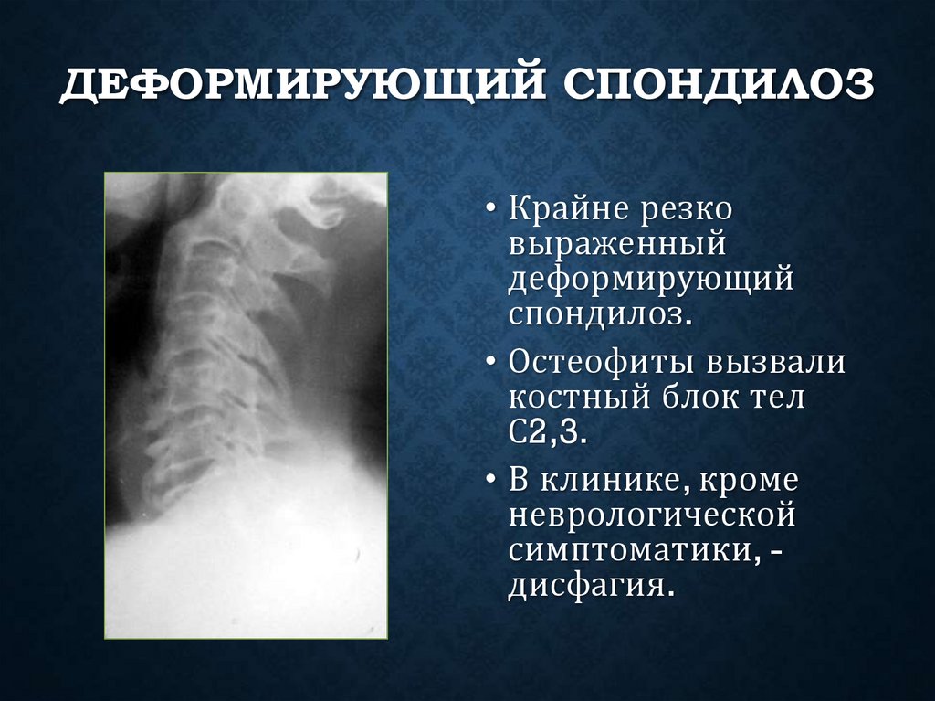 Деформирующий спондилоз
