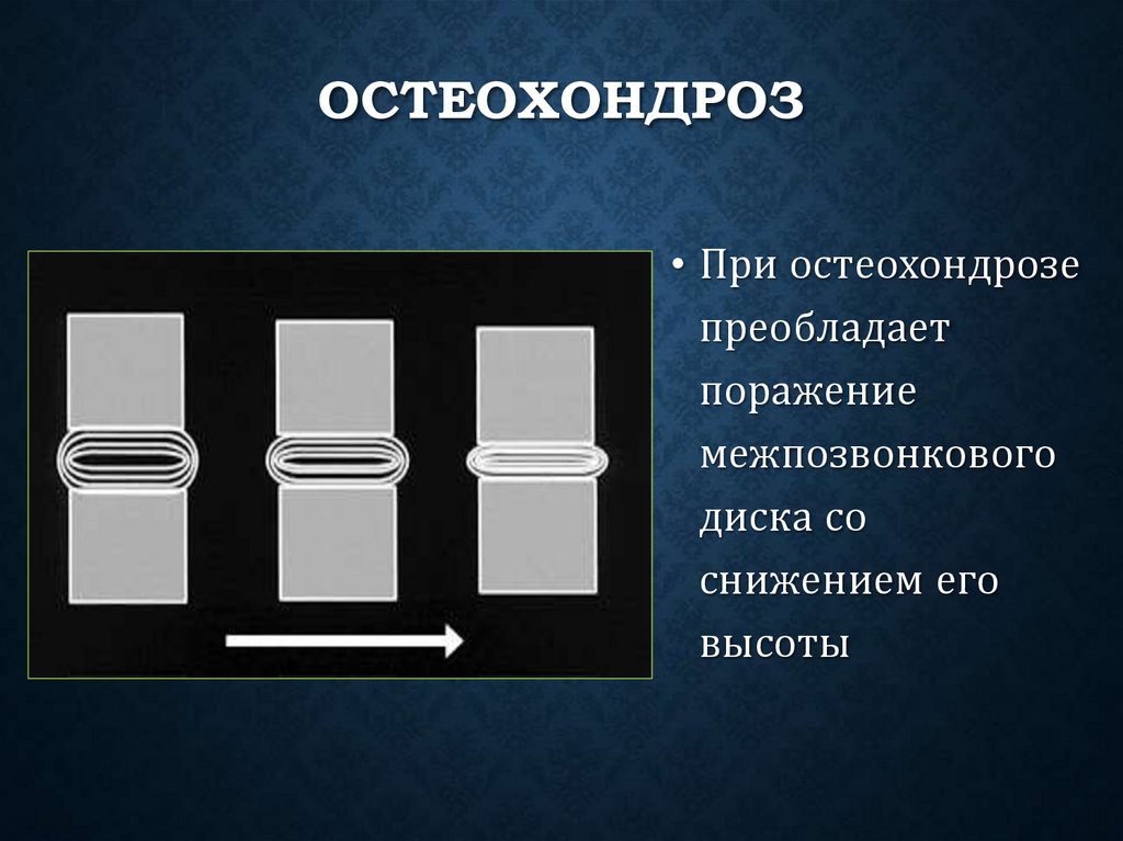 Остеохондроз