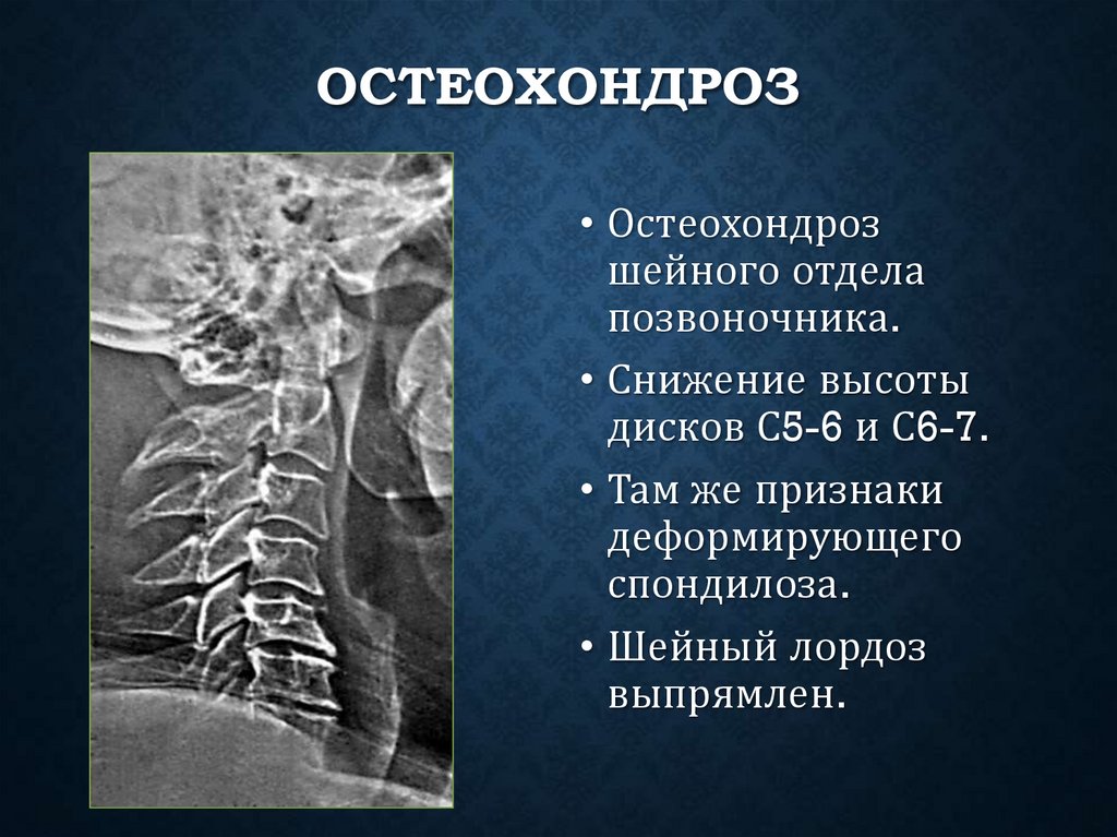 Остеохондроз