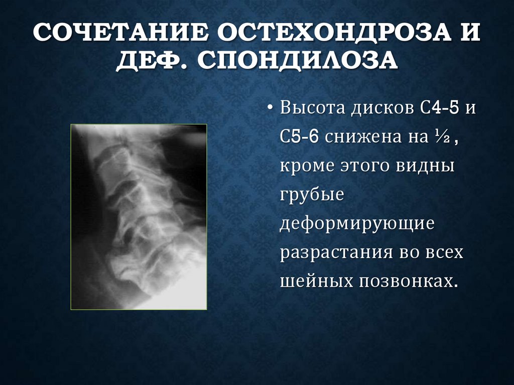 Сочетание остехондроза и деф. спондилоза