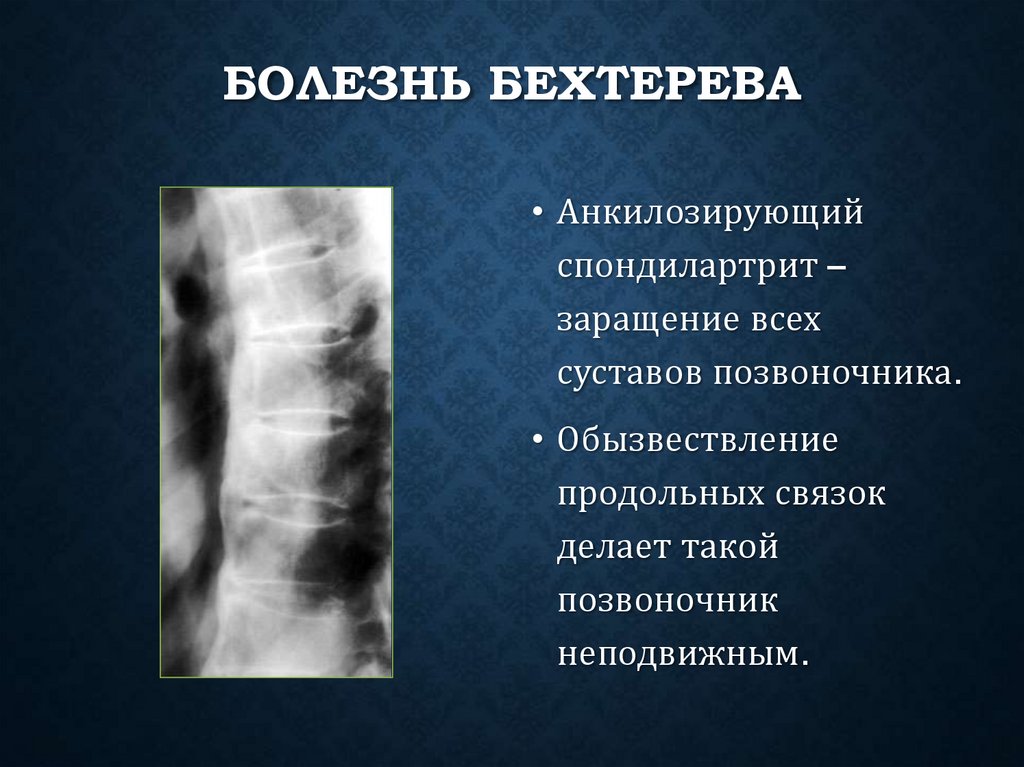 Болезнь Бехтерева