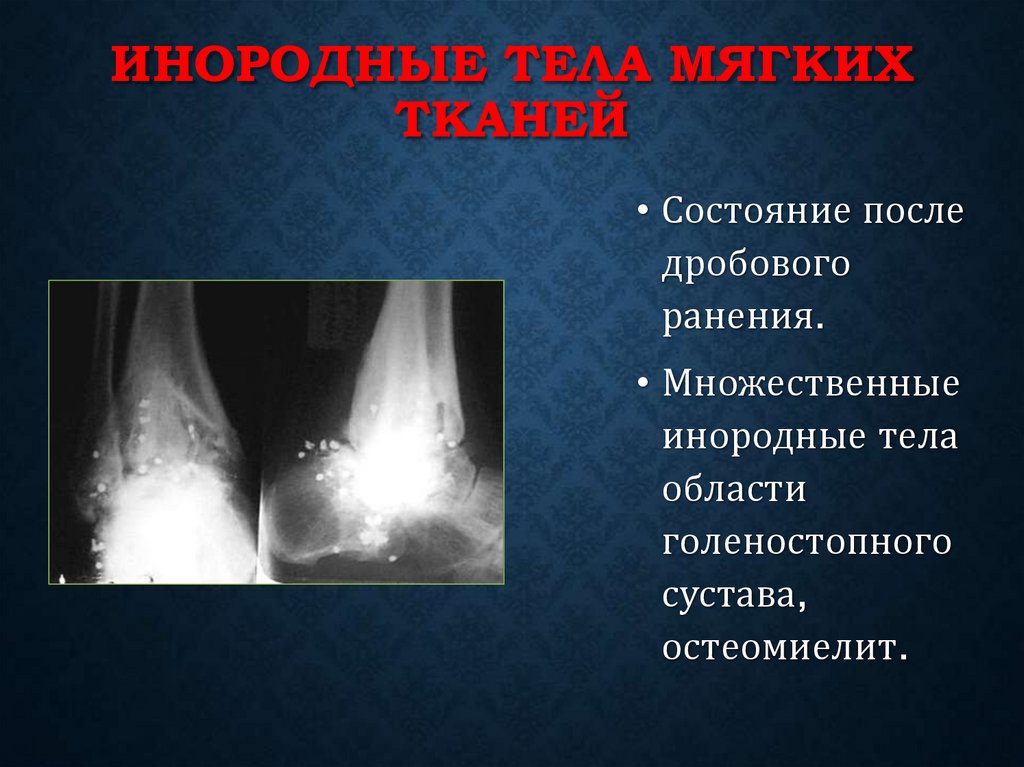 Инородные тела мягких тканей