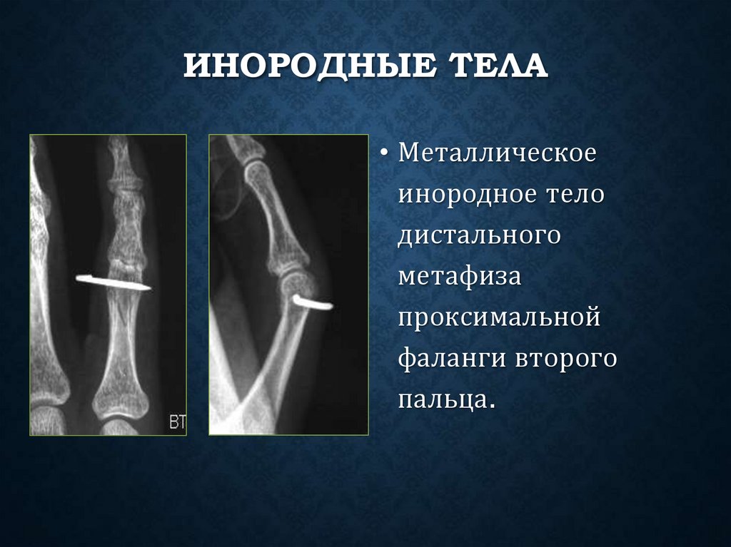 Инородные тела