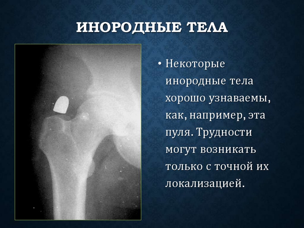 Инородные тела