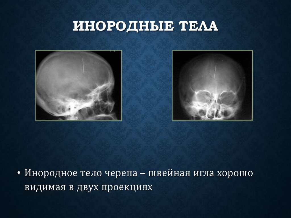 Инородные тела