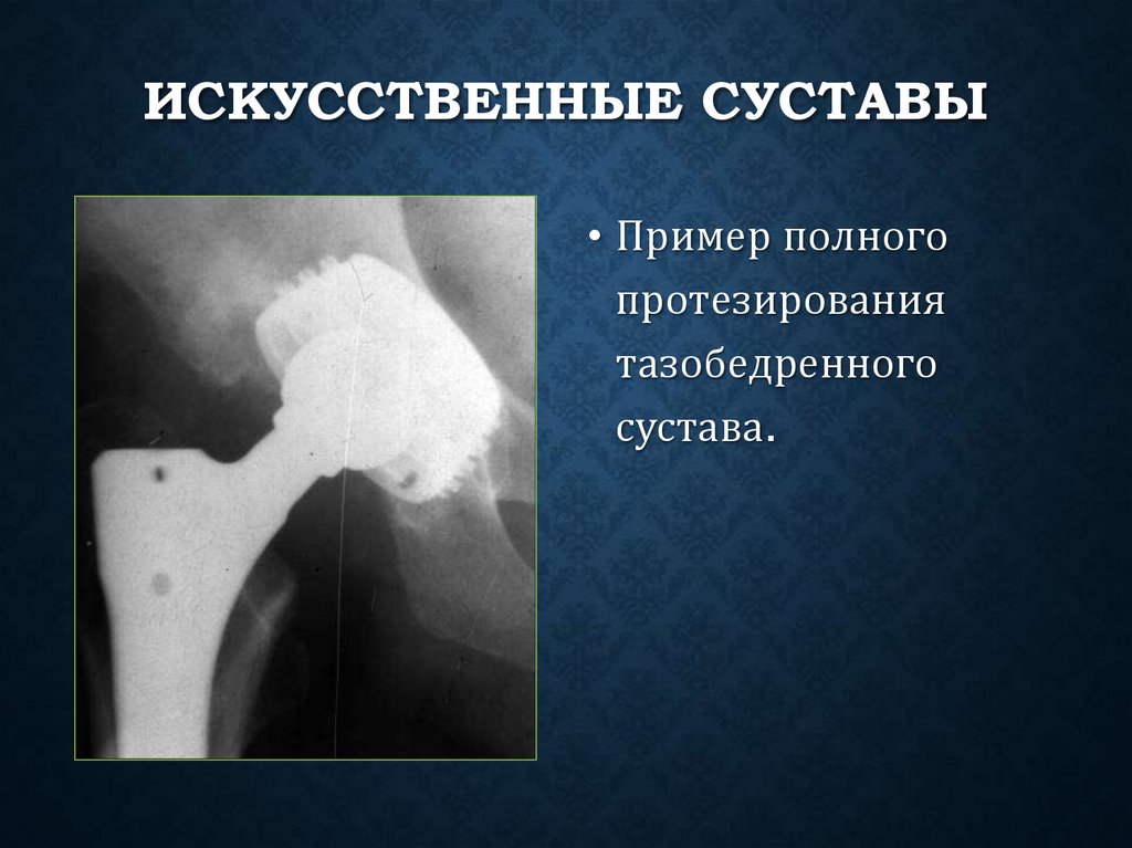Искусственные суставы