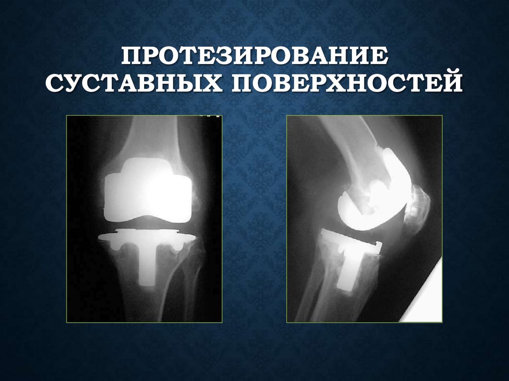 Протезирование суставных поверхностей