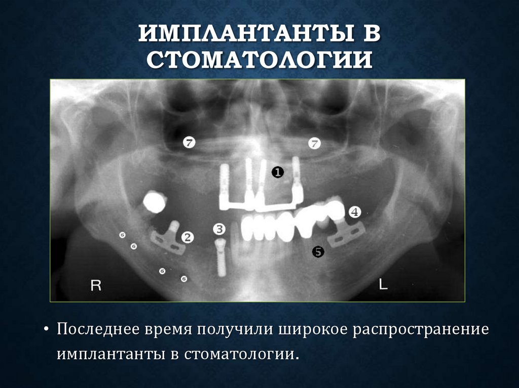 Имплантанты в стоматологии